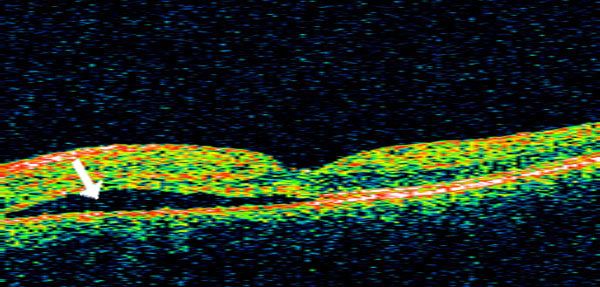 Central Serous Choroidoretinopathy