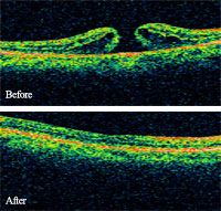 before and after macular holes